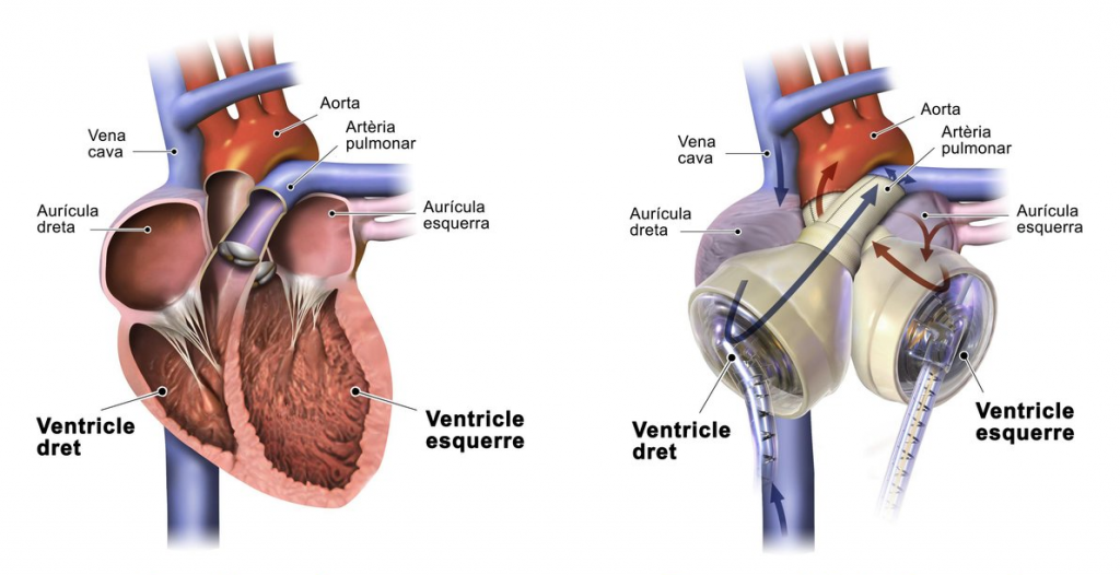 Lee más sobre el artículo El Hospital Universitario de Bellvitge implanta un corazón artificial por primera vez