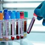 La Rioja | El CIBIR logra identificar biomarcadores para el diagnóstico precoz del cáncer de páncreas